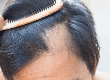 La solución definitiva a la caída del pelo
