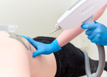 Cómo quitar un tatuaje con láser