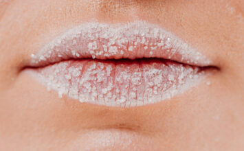 ¿Tienes puntos blancos en los labios? Te explicamos qué son