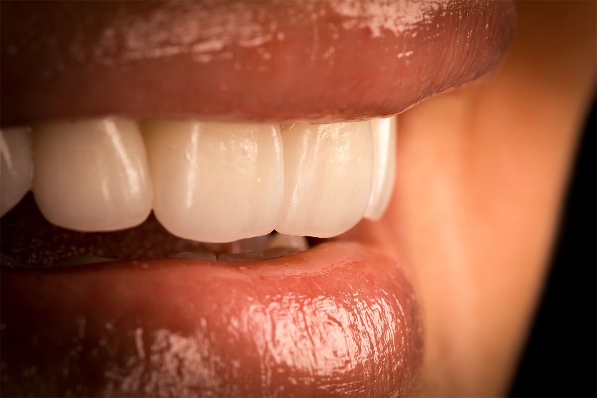 Tendencias en estética dental: ¿Por qué cada vez más personas eligen carillas de porcelana?